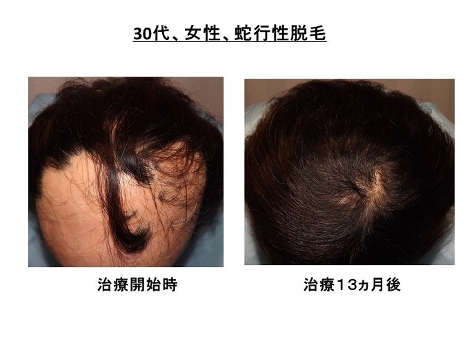 円形脱毛症　病院""